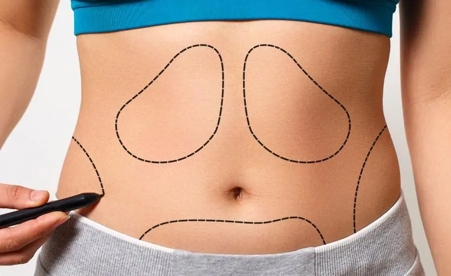 lipoliz ile liposuction arasındaki fark nedir